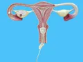 Kinderwunsch Inseminations-Set, schwanger werden , ICI intra cervical 30mm Cup
